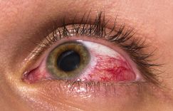 CBO-05-GLAUCOMA-DSKPT-IMG-06