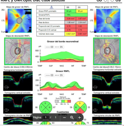 CBO-GLAUCOMA-CAR-XX-02