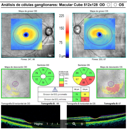 CBO-GLAUCOMA-CAR-XX-03